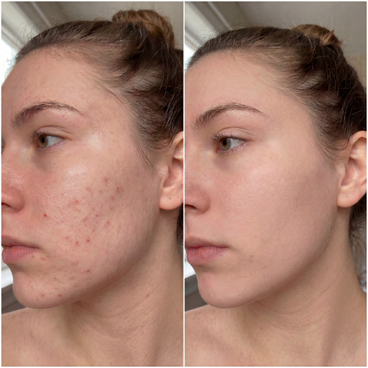Before and after comparison of a woman's face with acne on the left and smoother skin on the right.