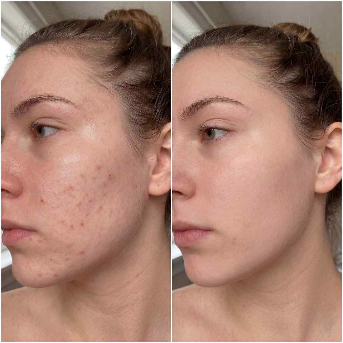 Best LED Face Mask for Acne — What to Look For and Why FDA Clearance Matters